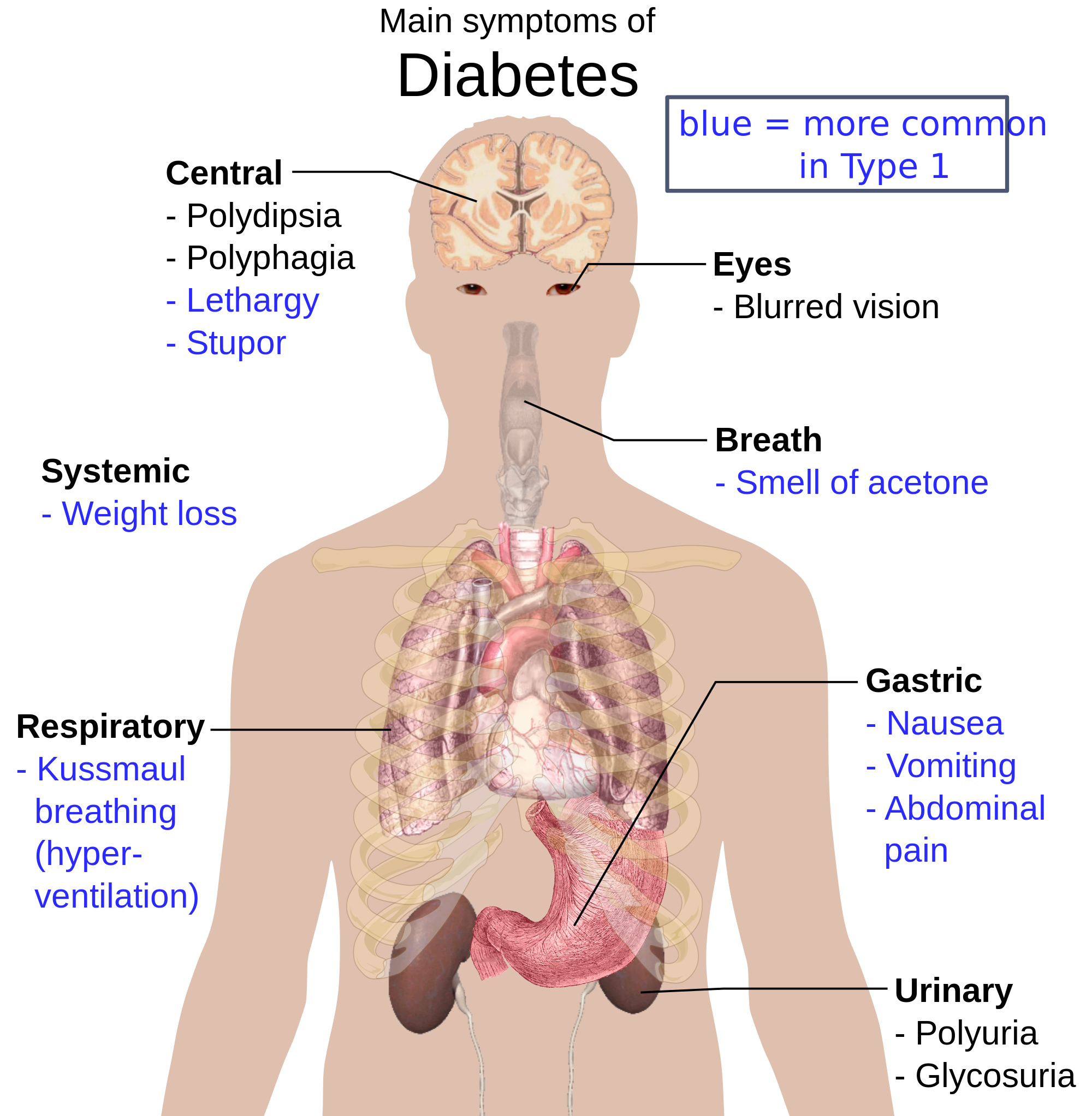 2000px-Main_symptoms_of_diabetes.svg